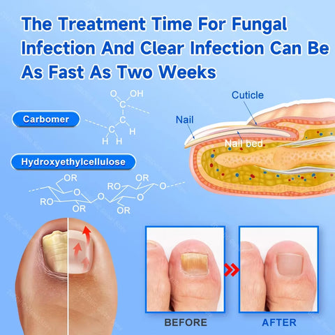 2-In-1 Fungal Nail Laser Device Repair Fast Nails Fungus Onychomycosis Repair Toenail Fingernail Removes Nail Fungus Foot Care